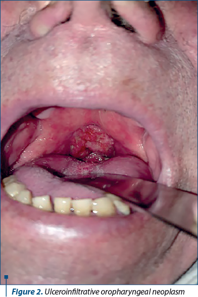 Figure 2. Ulceroinfiltrative oropharyngeal neoplasm