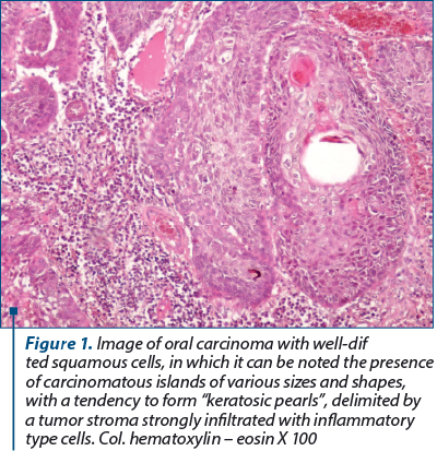 Figure 1. Image of oral carcinoma with well-dif­fe­ren­tia­ted squamous cells, in which it can be noted the presence of carcinomatous islands of various sizes and shapes, with a tendency to form “keratosic pearls”, delimited by a tumor stroma strongly infiltrated with inflammatory type cells. Col. hematoxylin – eosin X 100