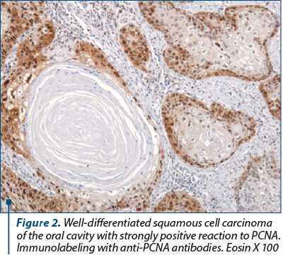 Figure 2. Well-differentiated squamous cell carcinoma of the oral cavity with strongly positive reaction to PCNA. Immunolabeling with anti-PCNA antibodies. Eosin X 100