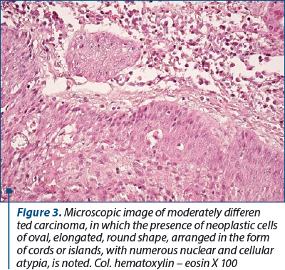 Figure 3. Microscopic image of moderately differen­tia­ted carcinoma, in which the presence of neoplastic cells of oval, elongated, round shape, arranged in the form of cords or islands, with numerous nuclear and cellular atypia, is noted. Col. hematoxylin – eosin X 100