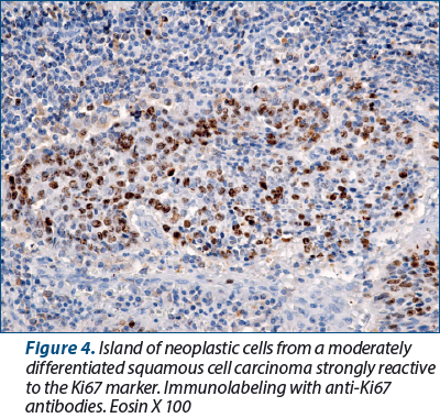 Figure 4. Island of neoplastic cells from a moderately dif­fe­ren­tiated squamous cell carcinoma strongly re­­active to the Ki67 marker. Immunolabeling with anti-Ki67 antibodies. Eosin X 100