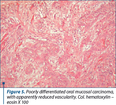 Figure 5. Poorly differentiated oral mucosal carcinoma, with apparently reduced vascularity. Col. hematoxylin – eosin X 100