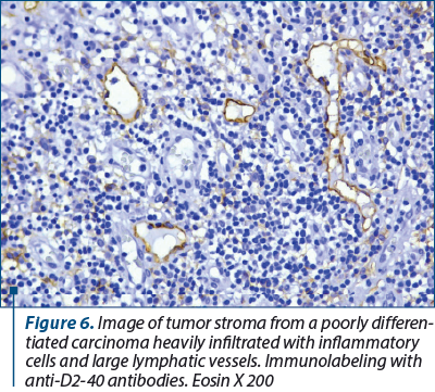 Figure 6. Image of tumor stroma from a poorly dif­fe­ren­tiated carcinoma heavily infiltrated with inflammatory cells and large lymphatic vessels. Immunolabeling with anti-D2-40 antibodies. Eosin X 200