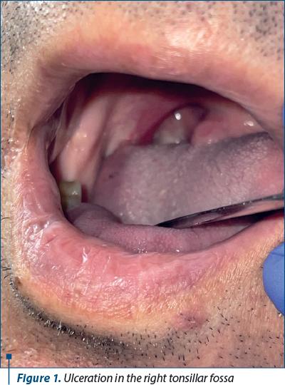 Figure 1. Ulceration in the right tonsillar fossa