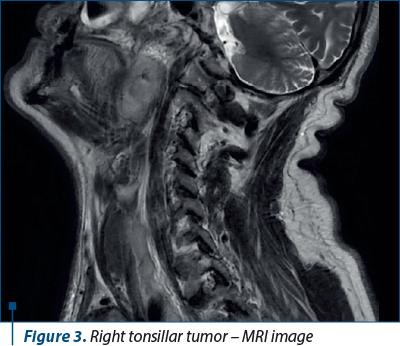 Figure 3. Right tonsillar tumor – MRI image