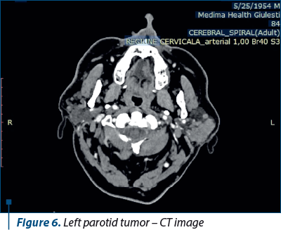 Figure 6. Left parotid tumor – CT image