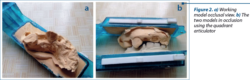 Figure 2. a) Working model occlusal view. b) The two models in occlusion using the quadrant articulator