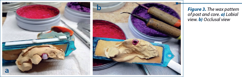 Figure 3. The wax pattern of post and core. a) Labial view. b) Occlusal view