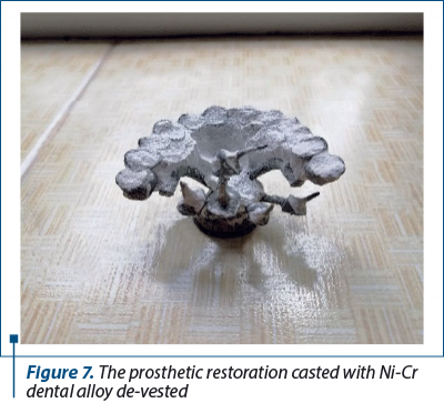 Figure 7. The prosthetic restoration casted with Ni-Cr dental alloy de-vested 