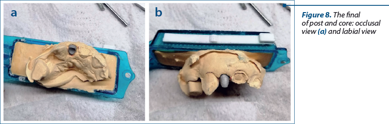 Figure 8. The final aspect of post and core: occlusal view (a) and labial view (b)