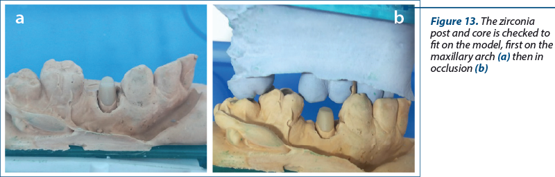 Figure 13. The zirconia post and core is checked to fit on the model, first on the maxillary arch (a) then in occlusion (b)