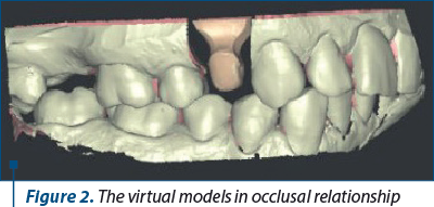 Figure 2. The virtual models in occlusal relationship 