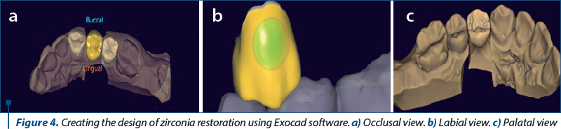 Figure 4. Creating the design of zirconia restoration using Exocad software. a) Occlusal view. b) Labial view. c) Palatal view
