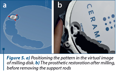 Figure 5. a) Positioning the pattern in the virtual image of milling disk. b) The prosthetic restoration after milling, before removing the support rods
