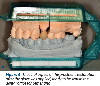 Figure 6. The final aspect of the prosthetic restoration, after the glaze was applied, ready to be sent in the dental office for cementing
