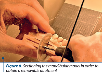 Figure 8. Sectioning the mandibular model in order to obtain a removable abutment 