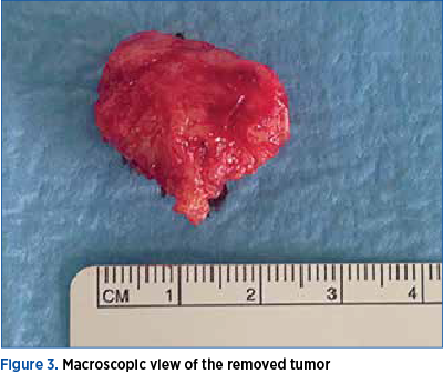 Figure 3. Macroscopic view of the removed tumor