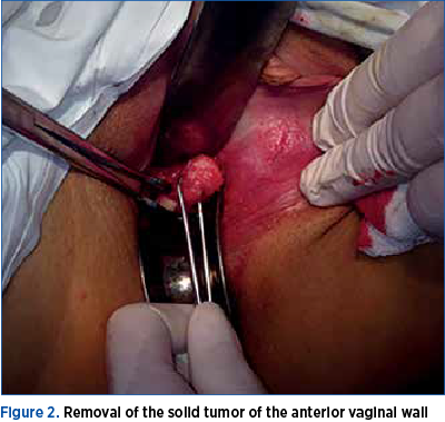 Figure 2. Removal of the solid tumor of the anterior vaginal wall