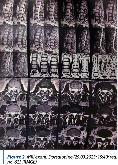 Figure 2. MRI exam. Dorsal spine (29.03.2023; 15:40; reg. no. 623 IRMGE)