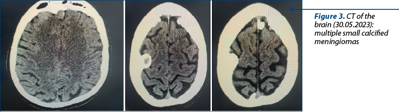 Figure 3. CT of the brain (30.05.2023): multiple small calcified meningiomas