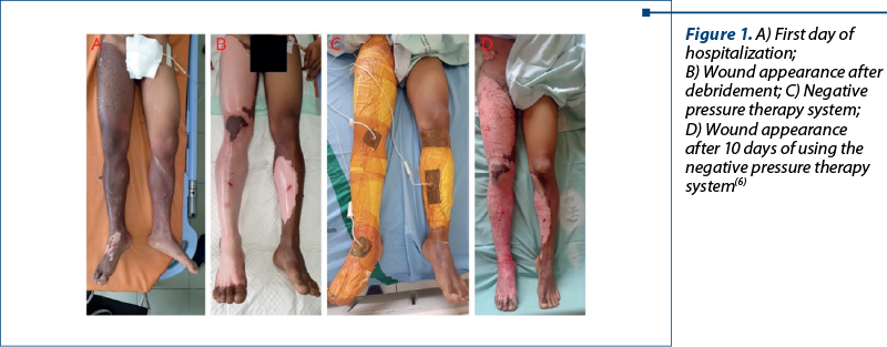 Figure 1. A) First day of hospitalization;  B) Wound appearance after debridement; C) Negative pressure therapy system;  D) Wound appearance after 10 days of using the negative pressure therapy system(6)