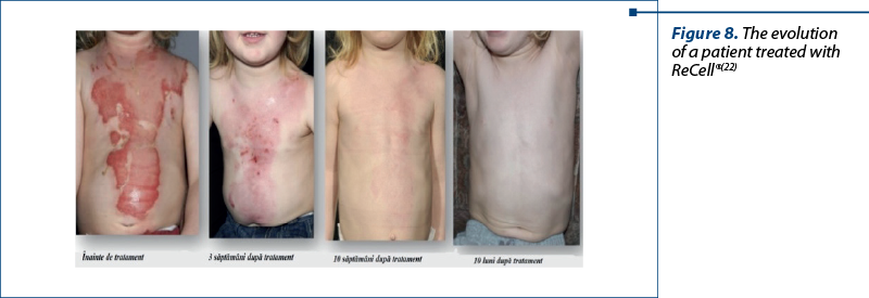 Figure 8. The evolution of a patient treated with ReCell®(22)