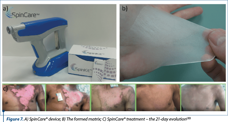 Figure 7. A) SpinCare® device; B) The formed matrix; C) SpinCare® treatment – the 21-day evolution(20)