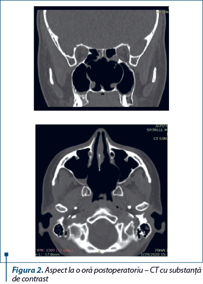 Figura 2. Aspect la o oră postoperatoriu – CT cu sub­stan­ţă de contrast
