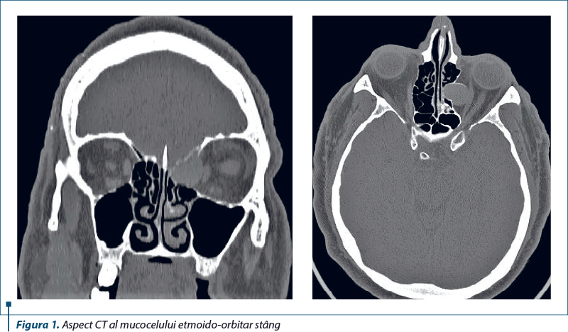 Figura 1. Aspect CT al mucocelului etmoido-orbitar stâng