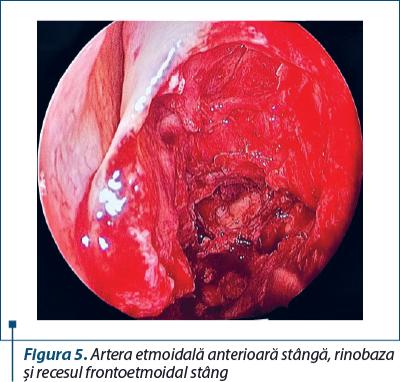 Figura 5. Artera etmoidală anterioară stângă, rinobaza şi recesul frontoetmoidal stâng
