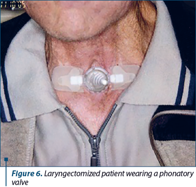 Figure 6. Laryngectomized patient wearing a phonatory valve