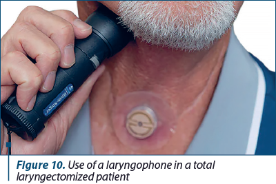 Figure 10. Use of a laryngophone in a total  laryngec­to­mized patient