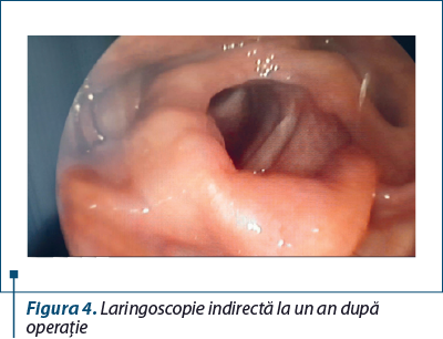Figura 4. Laringoscopie indirectă la un an după operaţie