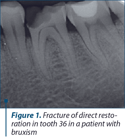 Figure 1. Fracture of direct resto­ra­tion in tooth 36 in a patient with bruxism