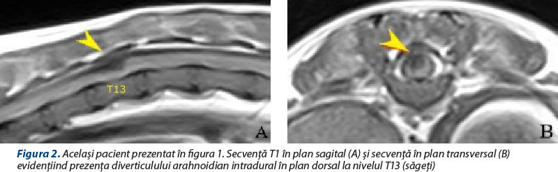 Figura 2. Acelaşi pacient prezentat în figura 1. Secvenţă T1 în plan sagital (A) şi secvenţă în plan transversal (B) evidenţiind prezenţa diverticulului arahnoidian intradural în plan dorsal la nivelul T13 (săgeţi)