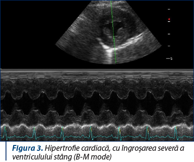 Figura 3. Hipertrofie cardiacă, cu îngroşarea severă a ventriculului stâng (B-M mode)