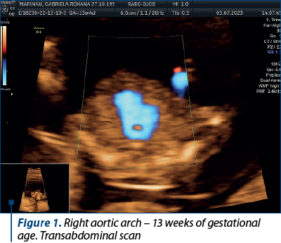Figure 1. Right aortic arch – 13 weeks of gestational age. Transabdominal scan