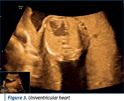 Figure 3. Univentricular heart 