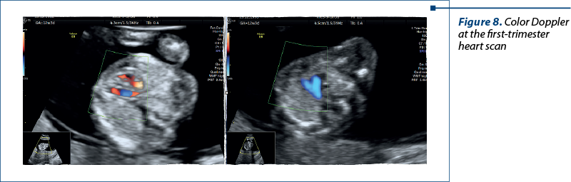 Figure 8. Color Doppler at the first-trimester heart scan