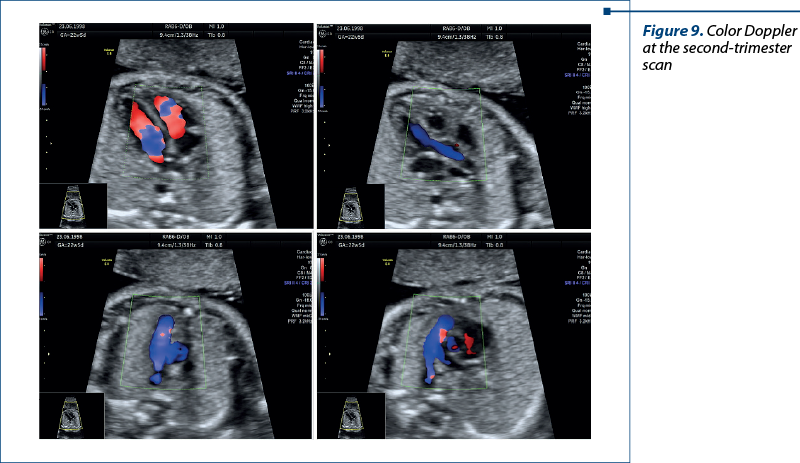 Figure 9. Color Doppler at the second-trimester scan