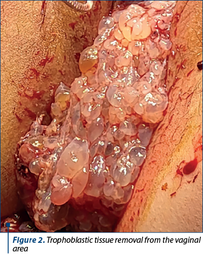 Figure 2. Trophoblastic tissue removal from the vaginal area 