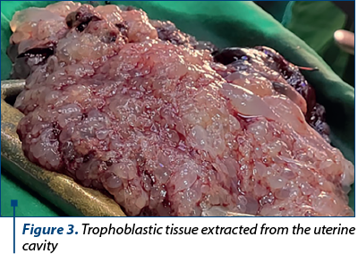 Figure 3. Trophoblastic tissue extracted from the uterine cavity