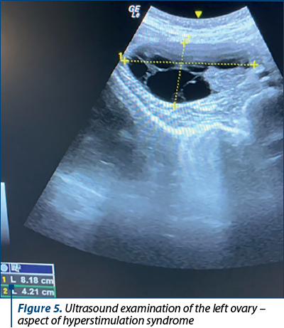 Figure 5. Ultrasound examination of the left ovary – aspect of hyperstimulation syndrome 