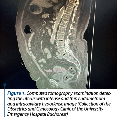 Figure 1. Computed tomography examination detec­ting the uterus with intense and thin endometrium and intracavitary hypodense image (Collection of the Obstetrics and Gynecology Clinic of the University Emergency Hospital Bucharest)