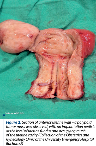 Figure 2. Section of anterior uterine wall – a polypoid tumor mass was observed, with an implantation pedicle at the level of uterine fundus and occupying much of the uterine cavity (Collection of the Obstetrics and Gynecology Clinic of the University Emergency Hospital Bucharest)