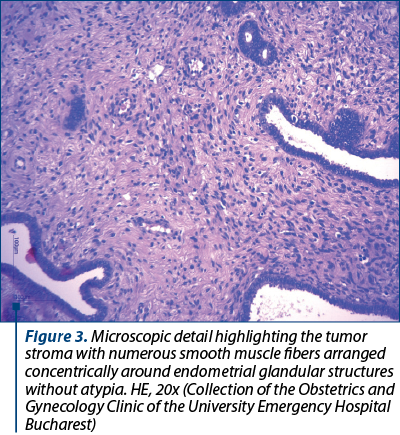 Figure 3. Microscopic detail highlighting the tumor stroma with numerous smooth muscle fibers arranged concentrically around endometrial glandular structures without atypia. HE, 20x (Collection of the Obstetrics and Gynecology Clinic of the University Emergency Hospital Bucharest)