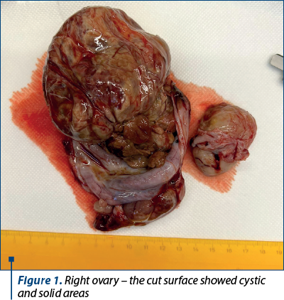Figure 1. Right ovary – the cut surface showed cystic and solid areas 
