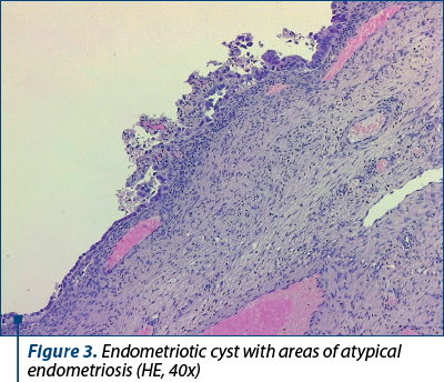 Figure 3. Endometriotic cyst with areas of atypical endometriosis (HE, 40x)