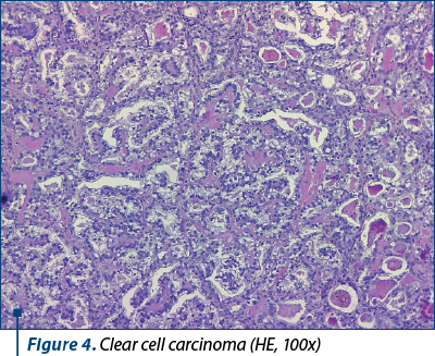 Figure 4. Clear cell carcinoma (HE, 100x)