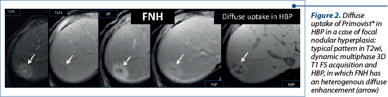 Figure 2. Diffuse uptake of Primovist® in HBP in a case of focal nodular hyperplasia: typical pattern in T2wi, dynamic multiphase 3D T1 FS acquisition and HBP, in which FNH has an heterogenous diffuse enhancement (arrow) 